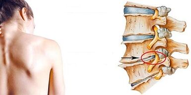 Cervical osteochondrose development mechanism