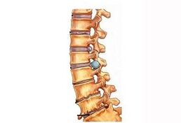 Stages of development of cervical osteochondrose