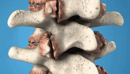 Osteofiti vertebrae - Pathological growth that damage nerves and blood vessels