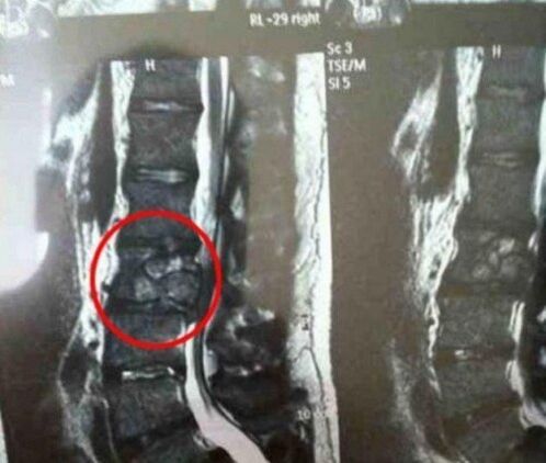 Tumor of spine in the picture