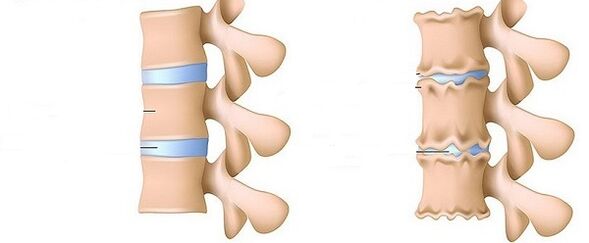 Healthy spine and osteochondrose
