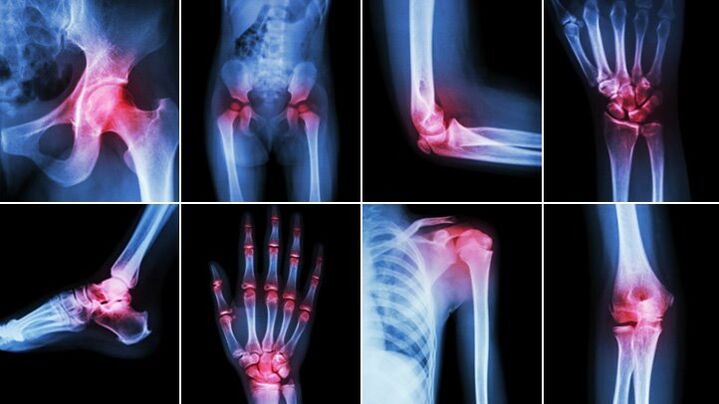 body joints affected by arthrosis